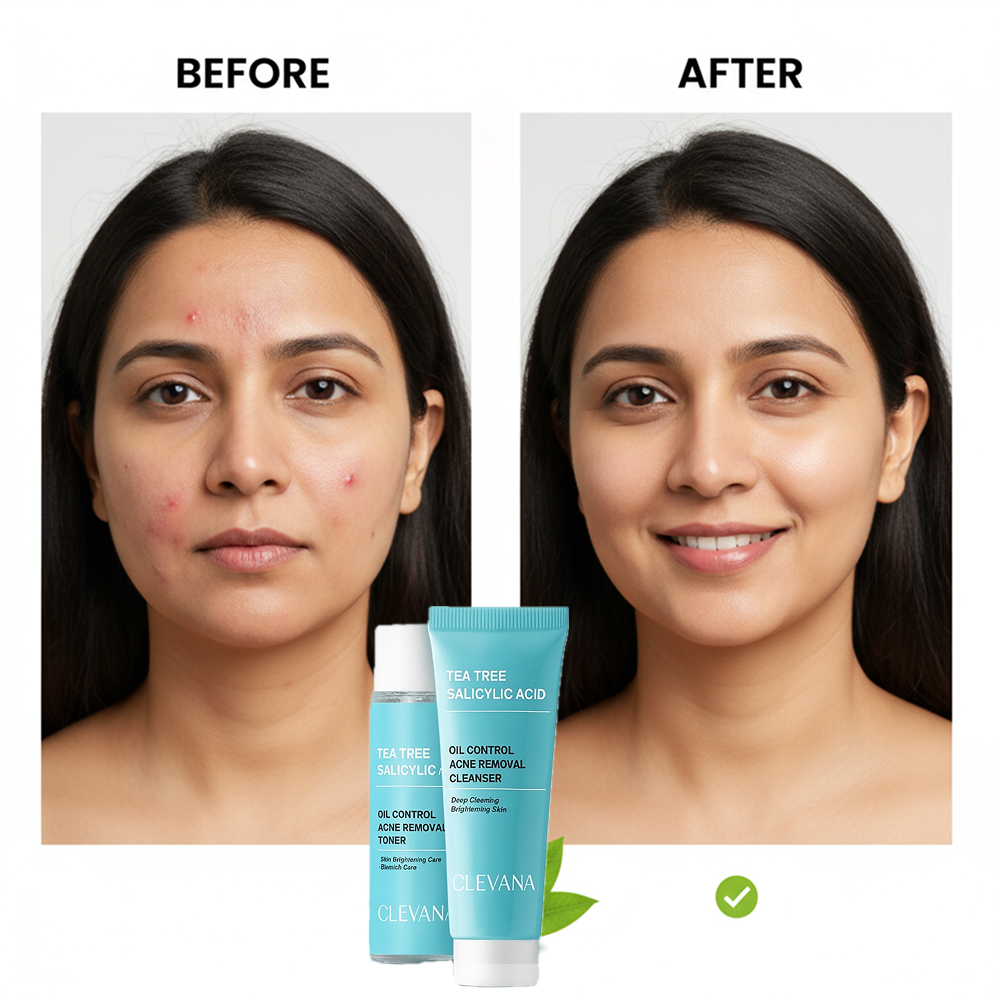 Clevana Oil Control Acne Removal Cream – Adult Acne Treatment with Tea Tree & Salicylic Acid